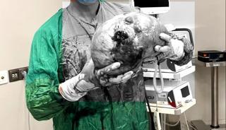 Yaşlı kadının karnından çıktı! Doktorlar inanamadı! Tam 4 kilo