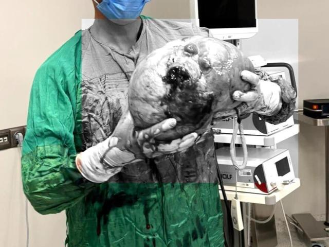 Yaşlı kadının karnından çıktı! Doktorlar inanamadı! Tam 4 kilo