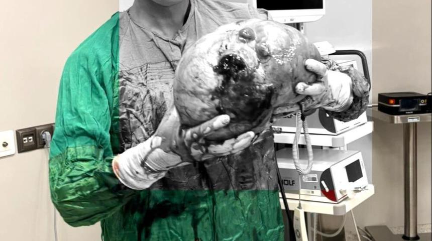 70 yaşındaki kadının karnından çıkarıldı! Tam 4 kilo, doktorlar bile inanamadı