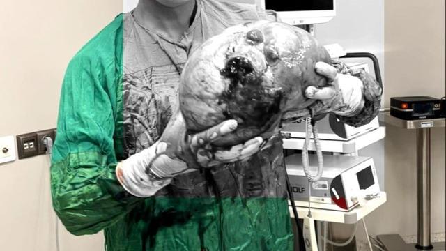 70 yaşındaki kadının karnından çıkarıldı! Tam 4 kilo, doktorlar bile inanamadı