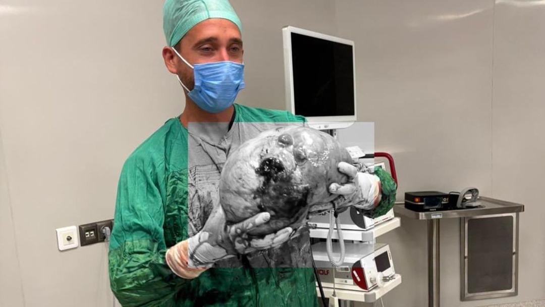 70 yaşındaki kadının karnından çıkarıldı! Tam 4 kilo, doktorlar bile inanamadı 1