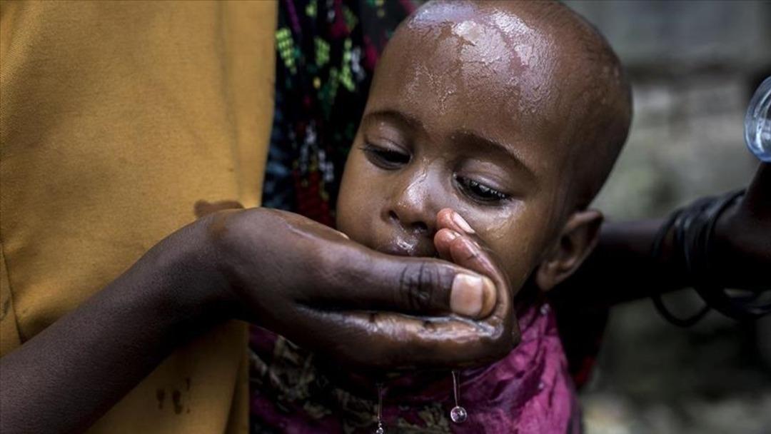 Kolera salgını alarmı! Yüzlerce vaka bildirildi: 13 kişi hayatını kaybetti! 2
