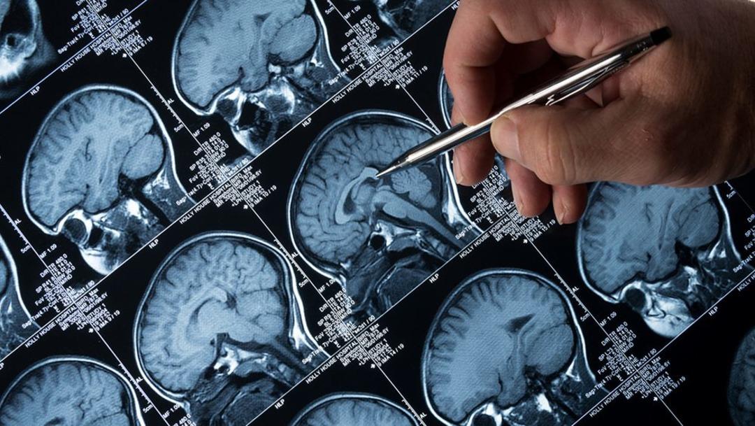 Beeindruckende neue Forschungsergebnisse aus Harvard: Neue Hoffnung für die Alzheimer-Behandlung! Experten: