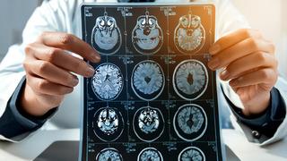 Harvard’dan çarpıcı yeni araştırma: Alzheimer tedavisine karşı yeni umut! Uzmanlar: Bu büyük bir dönüm noktası olabilir 