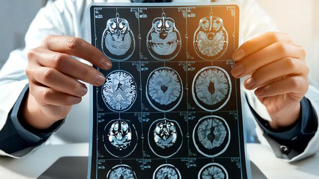 Harvard’dan çarpıcı yeni araştırma: Alzheimer tedavisine karşı yeni umut! Uzmanlar: Bu büyük bir dönüm noktası olabilir 
