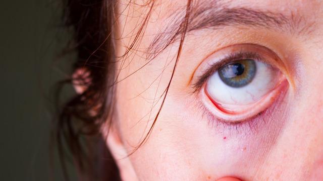 Göz altı morlukları neden olur, nasıl geçer? Göz altı morlukları için çözümler