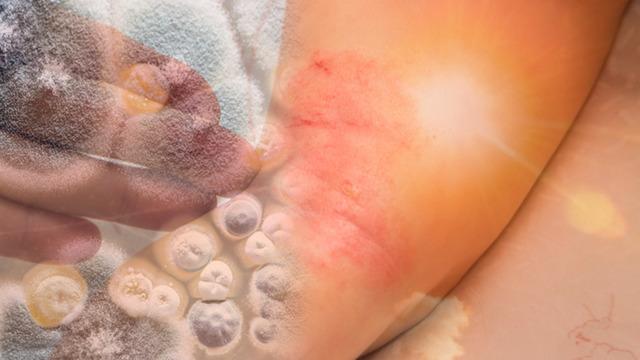 Sıcak ve nem tehlikeyi tetikliyor: Mantar enfeksiyonlarına dikkat! Diğer hastalıkların habercisi olabilir: Uzmanlar uyarıyor...