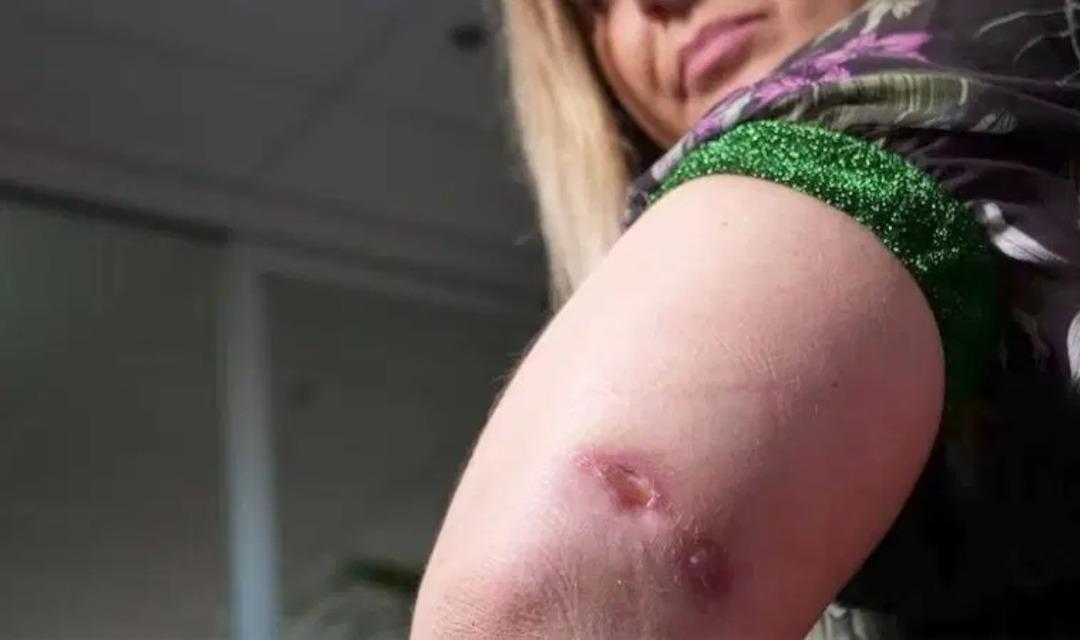  "Et yiyen bakteri" alarmı: Açık yaradan vücuda giriyor! 9 kişi öldü... 2