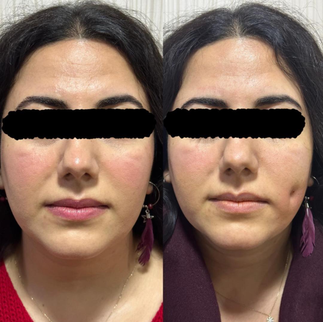 Yeni estetik çılgınlığı: Gamzeplasti ameliyatı sosyal medyada yayılıyor! 2