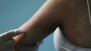 Sosyal medyadan aldığı 'cilt beyazlatıcı' krem az daha öldürüyordu! 4 gün yoğun bakımda kaldı: Yüzü kezzap dökülmüş gibiydi