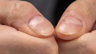 Vitamin eksikliği nasıl anlaşılır? Vitamin eksikliği belirtileri