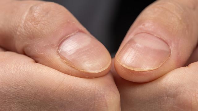 Vitamin eksikliği nasıl anlaşılır? Vitamin eksikliği belirtileri