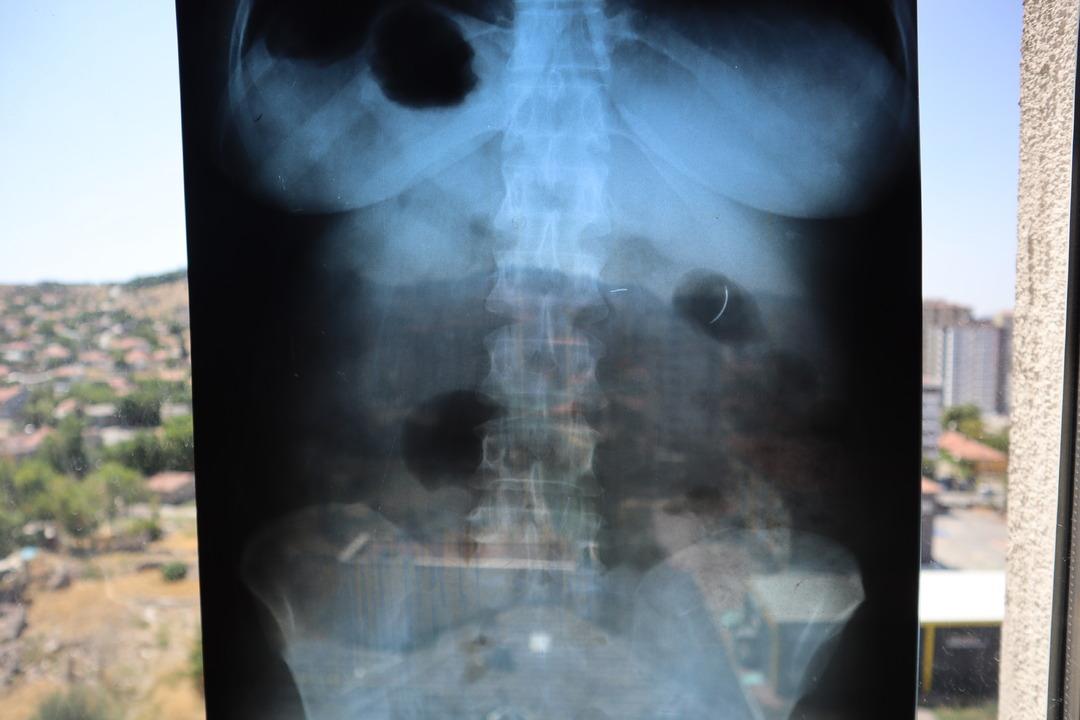 Tam 22 yıldır karnında yaşıyor! Riskli olduğu için çıkarılamıyor! "Yaşayan ölü gibiyim" 3