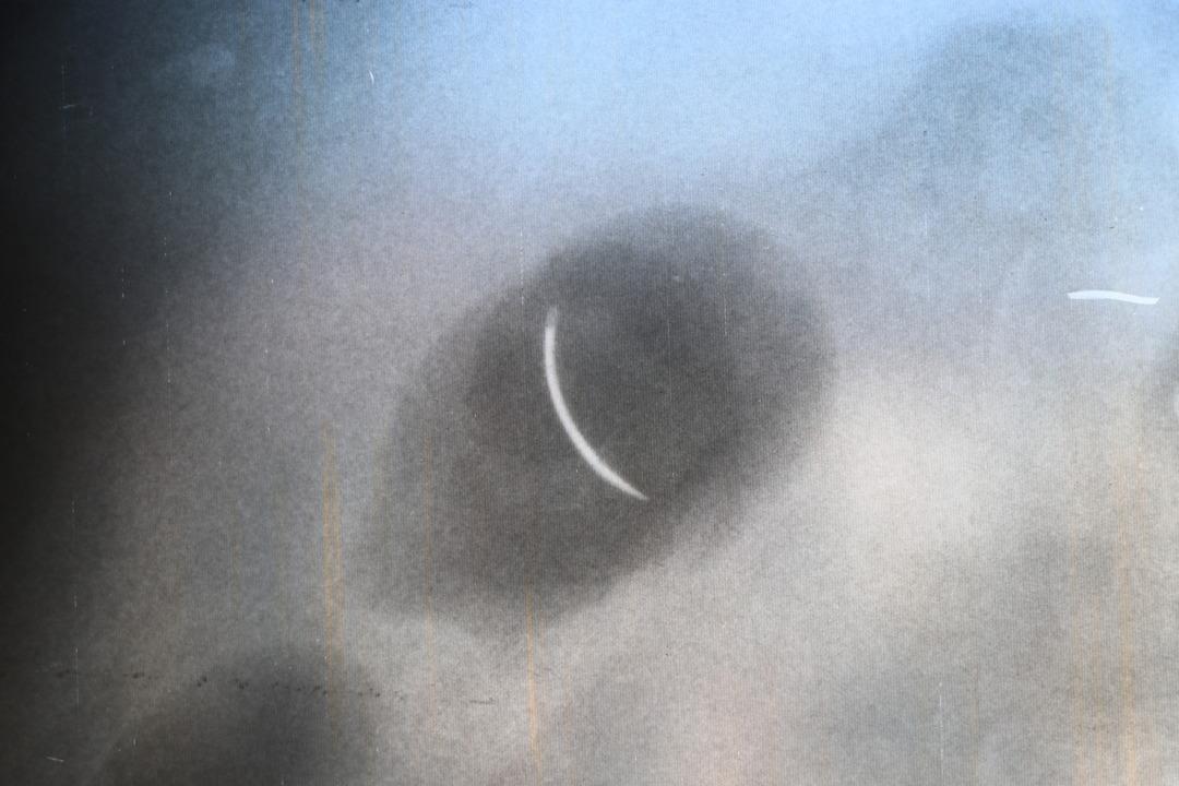 Tam 22 yıldır karnında yaşıyor! Riskli olduğu için çıkarılamıyor! "Yaşayan ölü gibiyim" 1