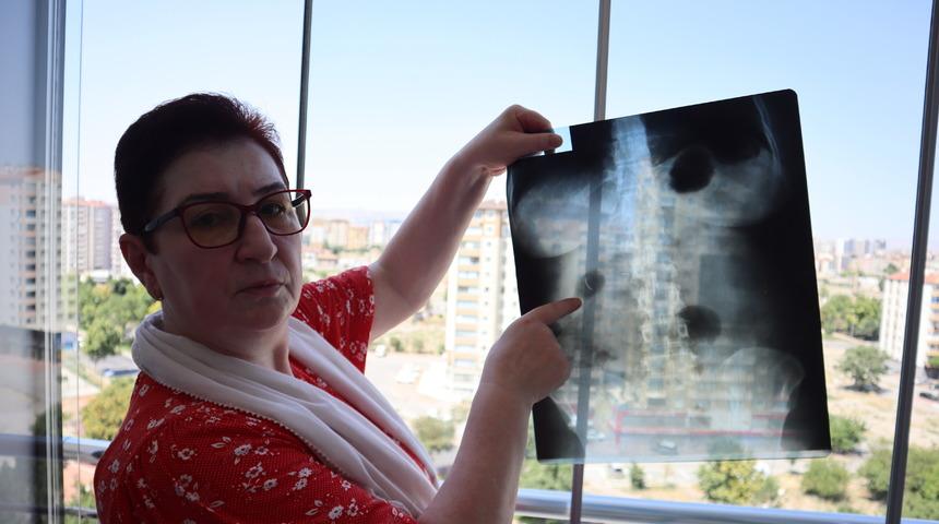 Tam 22 yıldır karnında yaşıyor! Riskli olduğu için çıkarılamıyor! "Yaşayan ölü gibiyim"