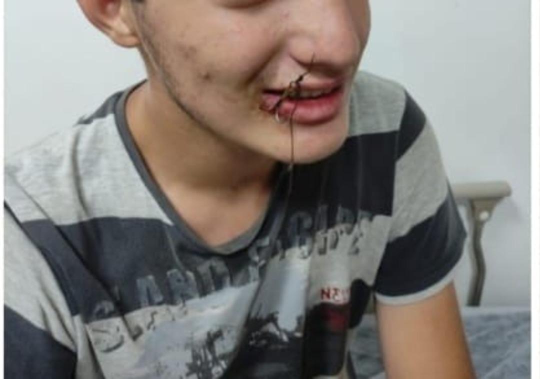 Ağzına balık oltası takılan çocuk, itfaiye ekiplerince kurtarıldı 1