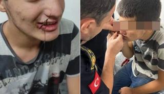 Ağzına balık oltası takıldı: Tedavi altına alındı
