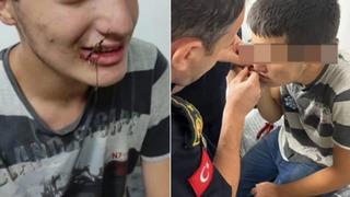 Ağzına balık oltası takılan çocuk, itfaiye ekiplerince kurtarıldı