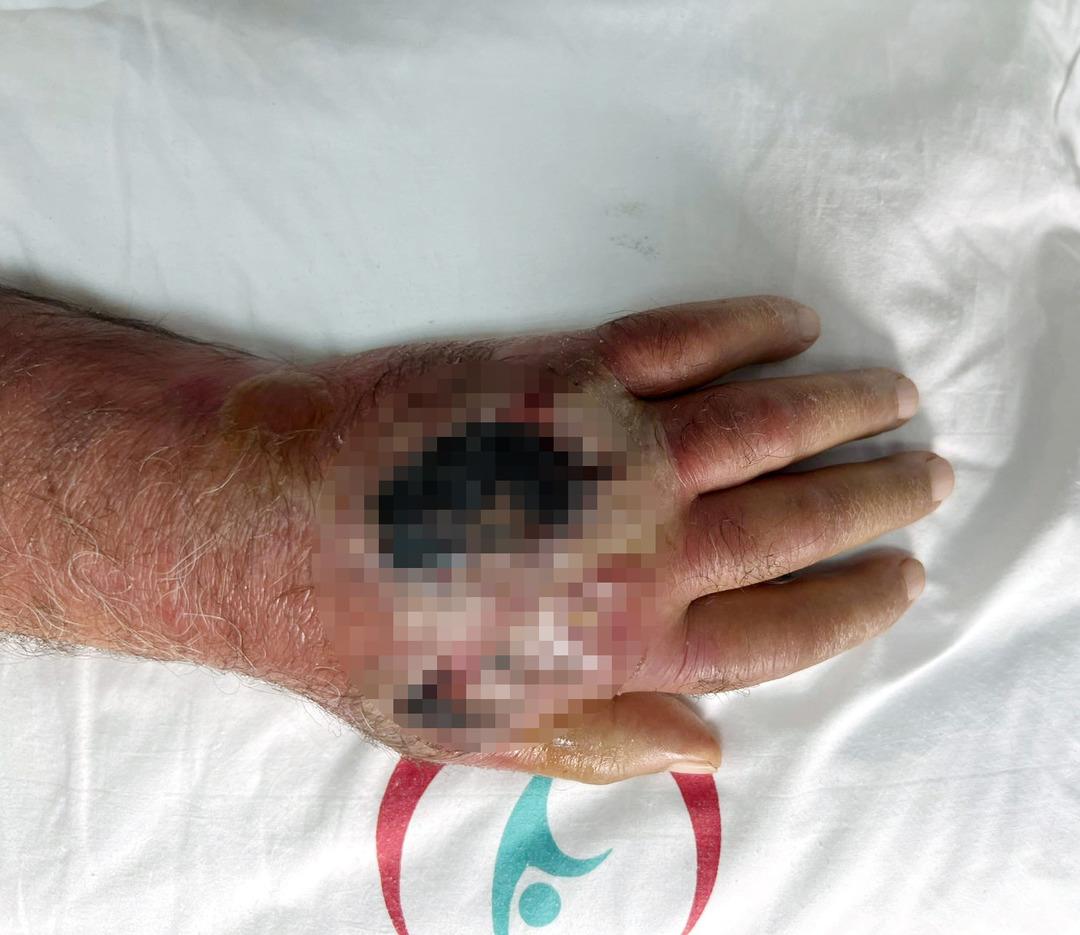 Bu bir insan ısırığı! Sakat kalmaktan son anda kurtarıldı... O tedavi literatüre girecek 2