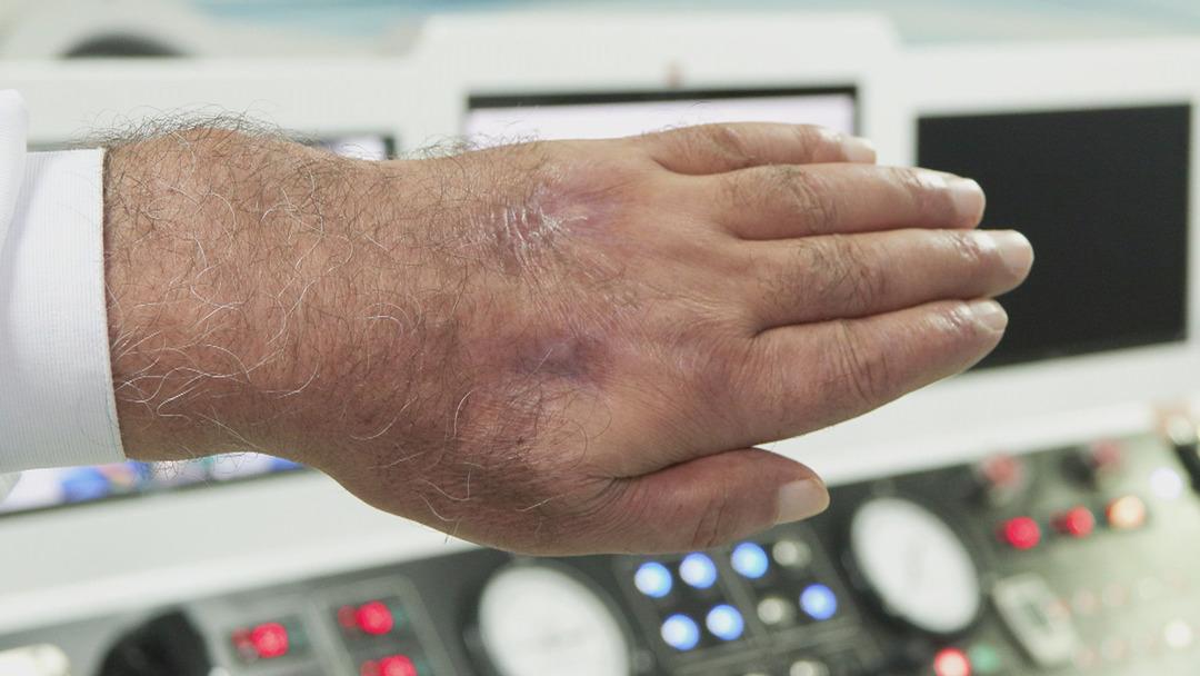 Bu bir insan ısırığı! Sakat kalmaktan son anda kurtarıldı... O tedavi literatüre girecek 5