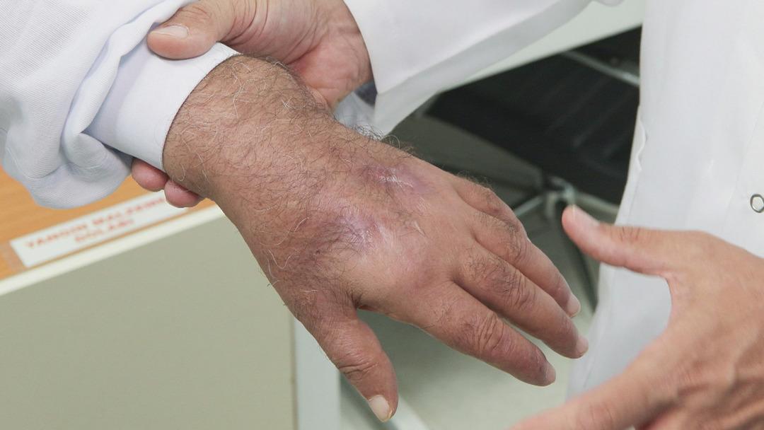 Bu bir insan ısırığı! Sakat kalmaktan son anda kurtarıldı... O tedavi literatüre girecek 3