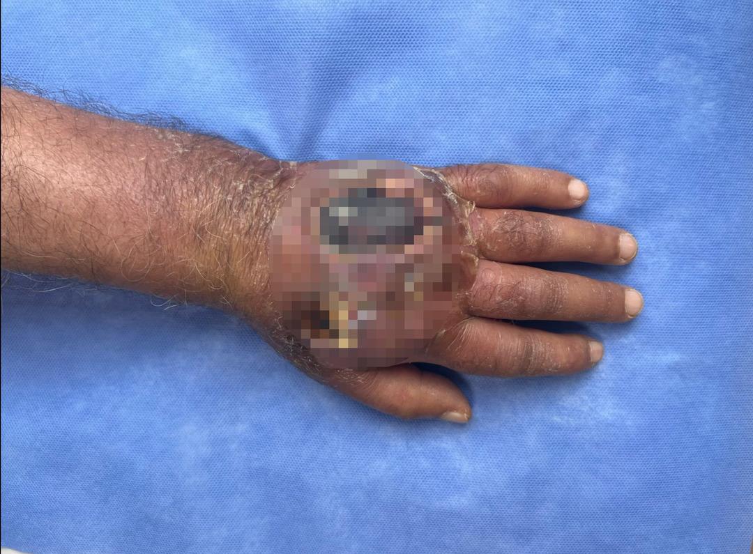 Bu bir insan ısırığı! Sakat kalmaktan son anda kurtarıldı... O tedavi literatüre girecek 1