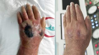 Bu bir insan ısırığı! Sakat kalmaktan son anda kurtarıldı... O tedavi literatüre girecek