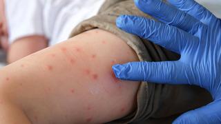 Yeni küresel salgın uyarısı: Chikungunya virüsü Türkiye'de var mı? Uzman isim açıkladı: Aedes türüne ait sivrisinek İstanbul'da görüldü 