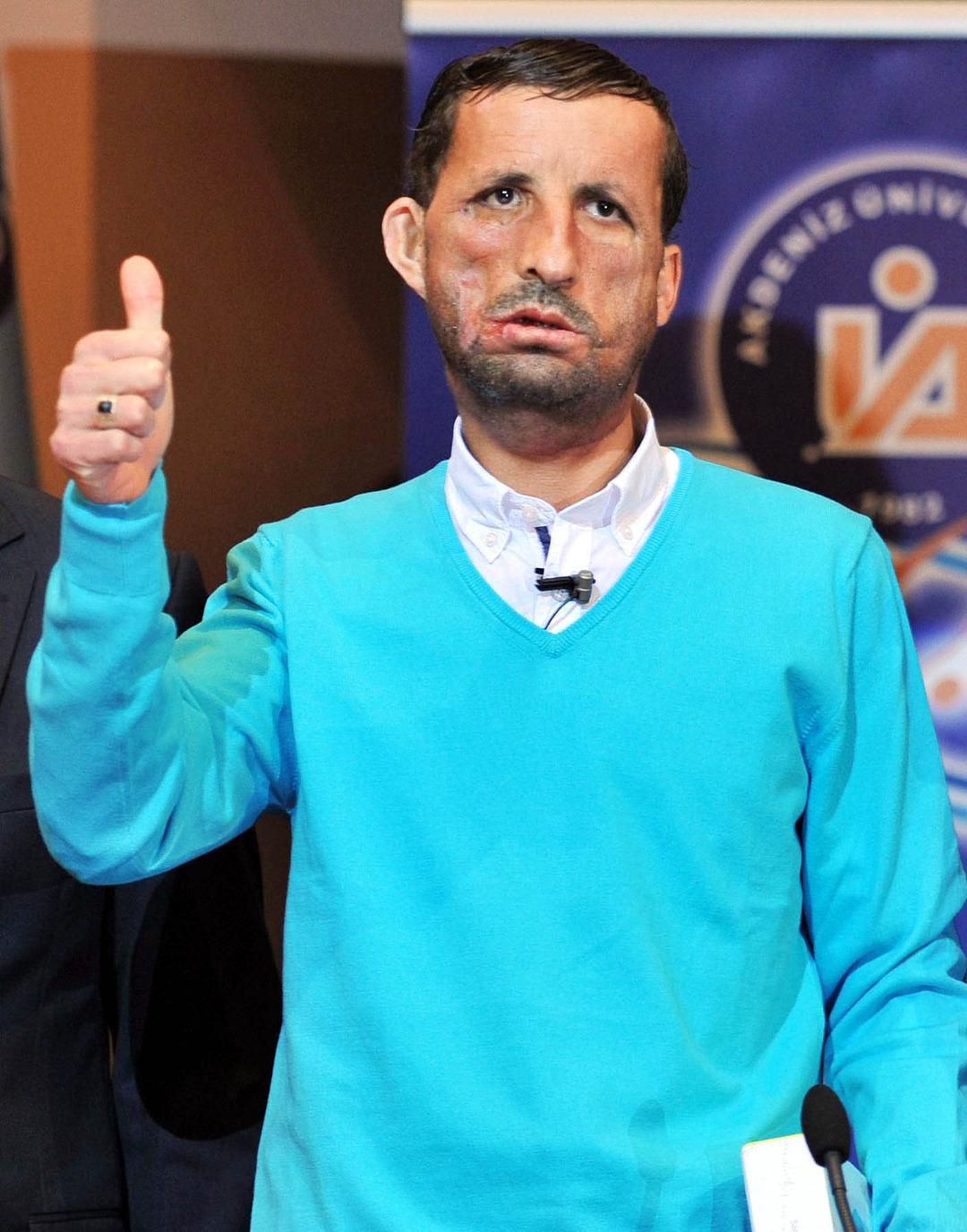  İlklerin merkezi  50 yıllık organ nakli üssüne yenisini ekledi: Akciğer nakline başlıyor... 3