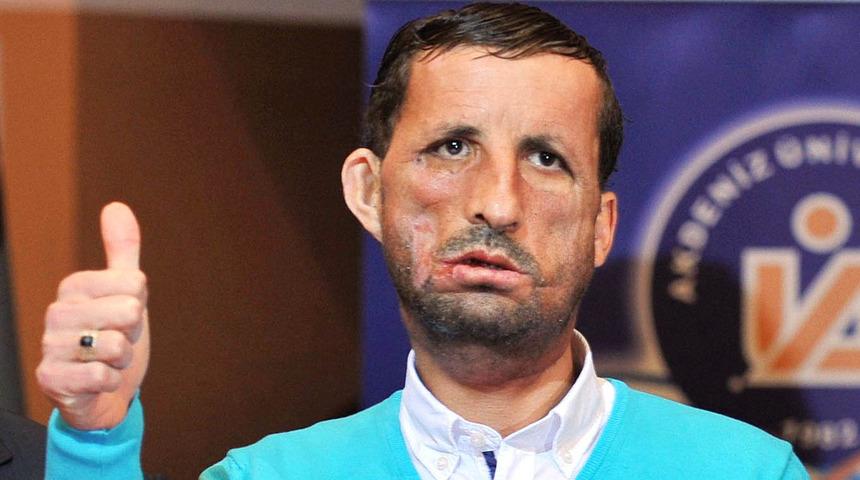 'İlklerin merkezi' 50 yıllık organ nakli üssüne yenisini ekledi: Akciğer nakline başlıyor...