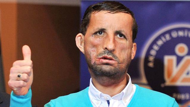 'İlklerin merkezi' 50 yıllık organ nakli üssüne yenisini ekledi: Akciğer nakline başlıyor...