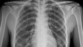 Ağrı şikayetiyle gitti göğsünden çıktı! 8 yıldır ordaymış