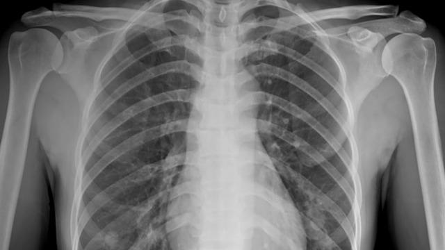 Ağrı şikayetiyle gitti göğsünden çıktı! 8 yıldır ordaymış