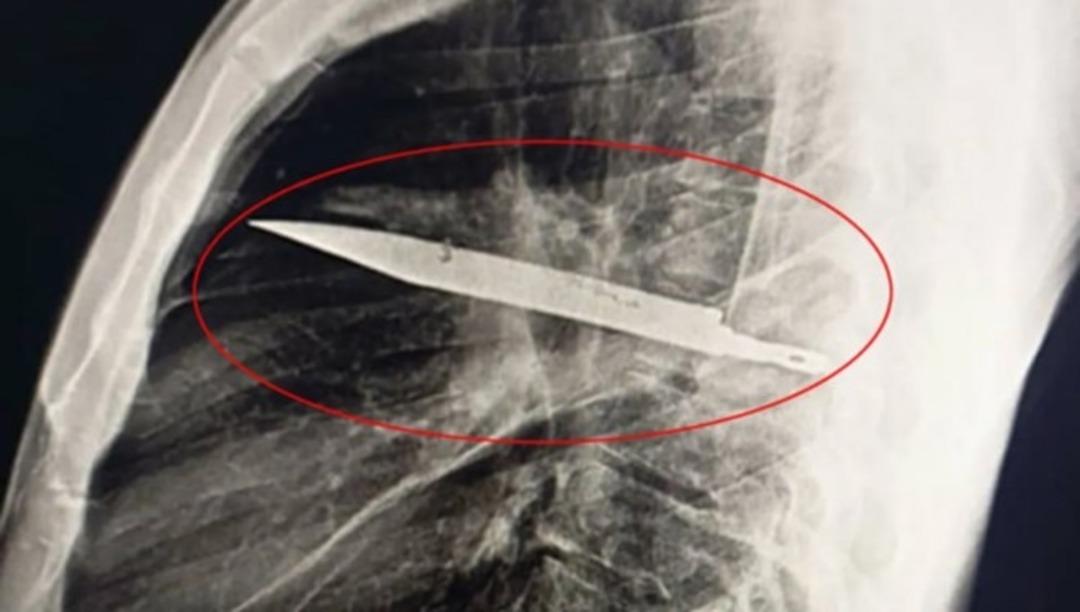 Ağrı şikayetiyle gitti göğsünden çıktı! 8 yıldır ordaymış 1