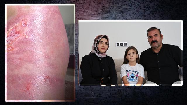 Düğünde korkunç olay! Üzerine dökülen sıvıyla hayatı karardı: 'Yanıyorum' diyerek yanıma gelince...