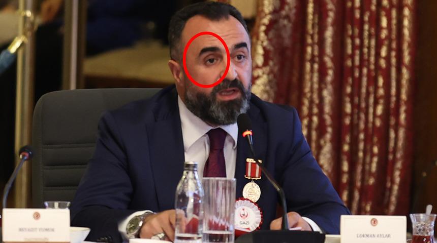 TBMM’deki komisyona damga vuran an! Sağ gözünü çıkarıp öyle anlattı