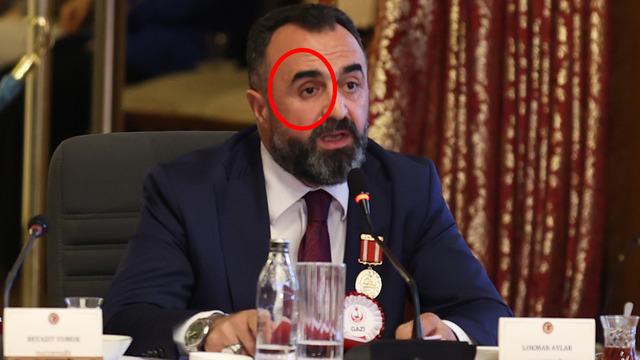 TBMM’deki komisyona damga vuran an! Sağ gözünü çıkarıp öyle anlattı