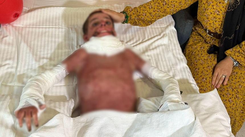 Mangal yaparken vücudunun yüzde 50'si yandı! 11 yaşındaki Mustafa'ya yapay deri nakli yapıldı...