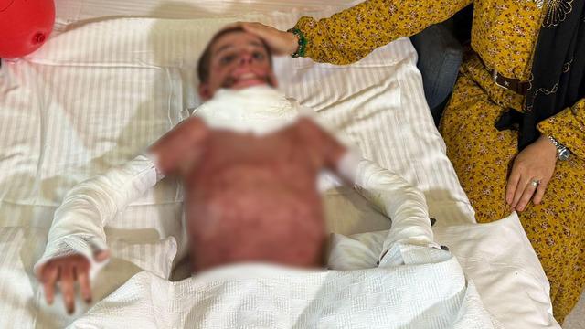 Mangal yaparken vücudunun yüzde 50'si yandı! 11 yaşındaki Mustafa'ya yapay deri nakli yapıldı...
