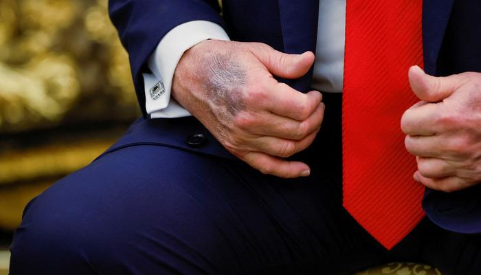 Bu defa makyajla gizlemedi! Trump'ın eli dünyada gündem oldu: Beyaz Saray'dan açıklama