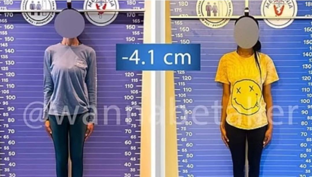 Akın akın Türkiye ye geliyorlar! Yeni moda boy kısaltma ameliyatı... Cerrahi paket bile yapmışlar: Ameliyat olana şehir gezisi, restoran turları ve tekne turu... 1