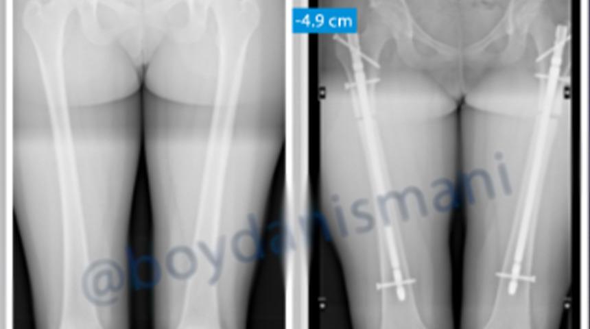 Akın akın Türkiye'ye geliyorlar! Yeni moda boy kısaltma ameliyatı... Cerrahi paket bile yapmışlar: Ameliyat olana şehir gezisi, restoran turları ve tekne turu...
