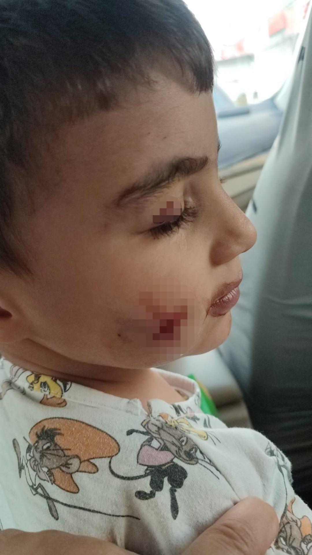 Evinde uyurken kabusa uyandı! Ankara da bir çocuğu lağım faresi ısırdı 1