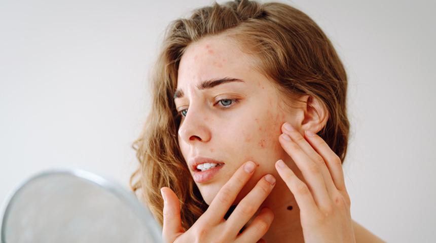 Yaz bitiyor, cilt lekeleri ortaya çıkıyor! Uzmanlar uyardı: Lekelerin yeniden oluşmasını önlemek için bunlara dikkat...