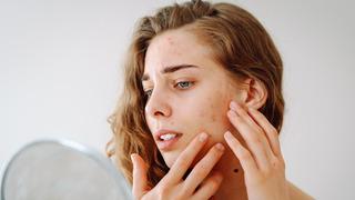 Yaz bitiyor, cilt lekeleri ortaya çıkıyor! Uzmanlar uyardı: Lekelerin yeniden oluşmasını önlemek için bunlara dikkat...