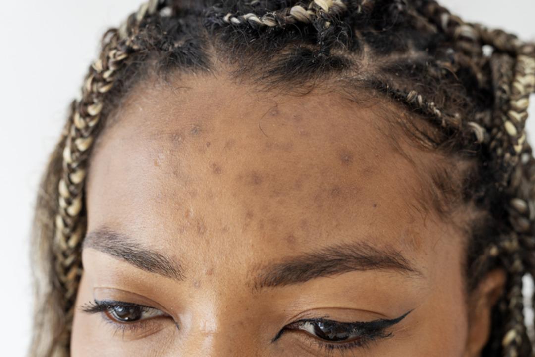 Yaz bitiyor, cilt lekeleri ortaya çıkıyor! Uzmanlar uyardı: Lekelerin yeniden oluşmasını önlemek için bunlara dikkat... 1