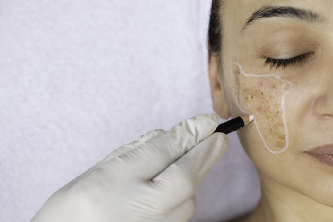 MYNET ÖZEL | Yaz lekeleri cildinizde çukur kazmasın! Leke tedavisinde en sık görülen 6 yanlış! Evde leke tedavisi yapılır mı? Uzman isim uyardı… 1