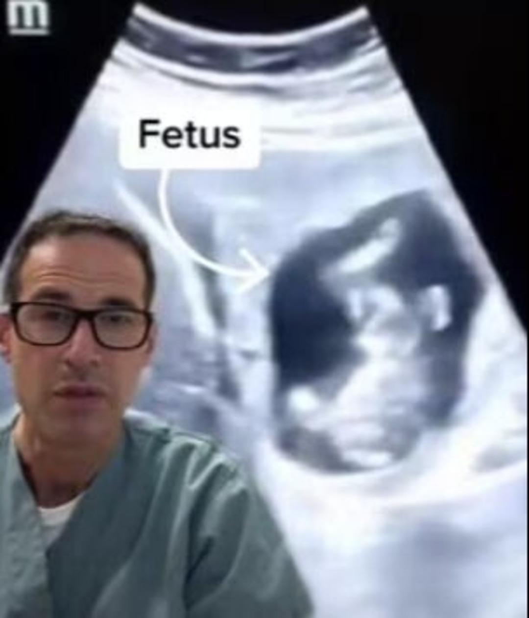 Tıp dünyası şokta! Genç kadının karaciğerinde 12 haftalık bebek bulundu 1