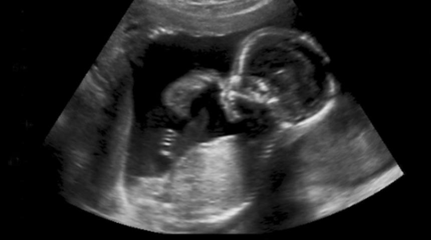 Tıp dünyası şokta! Genç kadının karaciğerinde 12 haftalık bebek bulundu