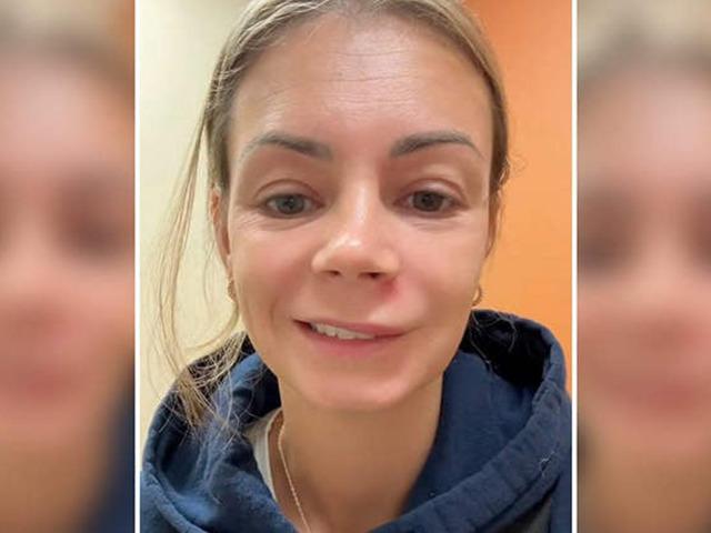 'Ölüm Üçgeni'nde sivilcesini patlatan kadın yüz felci geçirdi!